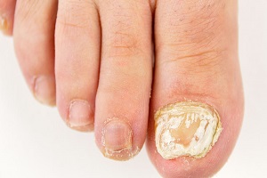 灰指甲疾病有哪一些危害
